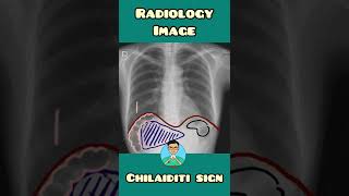 Chilaiditi Sign  Radiology Image  shorts [upl. by Sergio]