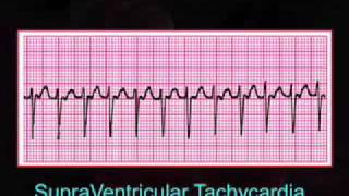 Introduction to EKG Rhythm Interpretation Part 3 [upl. by Enaenaj]