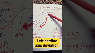 Left cardiac axis deviationmbbs physiology shorts [upl. by Sauncho]