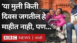 Conjoined twins Inspiring Story  ‘या मुली किती दिवस जगतील हे माहीत नाही पण [upl. by Meenen]