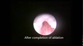 Posterior Urethral Valve Laser Ablation [upl. by Oneil]