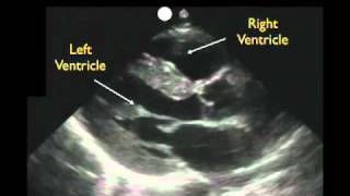 Cardiac Ultrasound  Parasternal Long Axis  Part 1  Sonosite Inc [upl. by Cirilo]