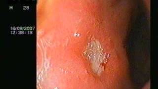 DUODENAL ULCER ON ENDOSCOPY [upl. by Yenaj721]