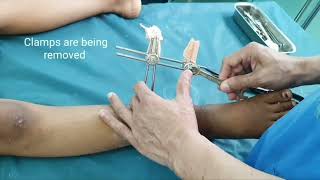 Paediatric fractures  External Fixator Removal  Fiberglass plastering  Adamya Hospital Videos [upl. by Yenruoc]