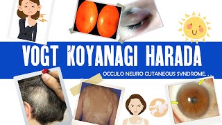 Vogt Koyanagi Harada syndrome  VKH  granulomatous uveitis  ophthalmology [upl. by Yelsnia]