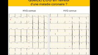 Infarctus ou et HVG  Quiz Dr Taboulet [upl. by Tut]