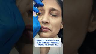 Xanthelasma Treatment  Skin Clinic  Kolkata  Skin Treatment  youtubereels youtubeshorts [upl. by Dolhenty]