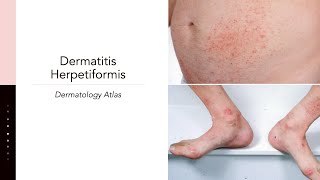 Dermatitis Herpetiformis [upl. by Eversole]