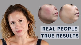 ProfhiloHydro Deluxe  Real People True Results [upl. by Leen]