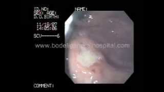 CANCER STOMACH  ENDOSCOPY GUJARATINDIA BODELI [upl. by Enomas]