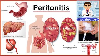 Waht is the peritonitis Acute AbdomenAppendicitis amp Peritonitis General Surgery LectureMrcsFrcs [upl. by Llyrad306]