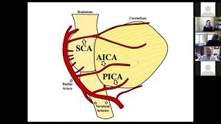 Management of Posterior Circulation Stroke Syndrome Sept 28 2021 [upl. by Wyatan]