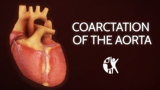 Coarctation of the Aorta [upl. by Trilbee993]