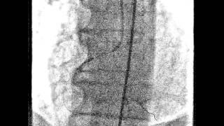 Acute inferior myocardial infarction [upl. by Ansell]