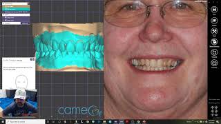 Smile Design 3D  Exocad [upl. by Aneej]