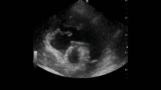 Right ventricular thrombus in a hypoalbuminaemic dog [upl. by Melessa969]