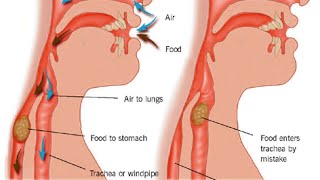 Aspiration Pneumonia [upl. by Zoellick]