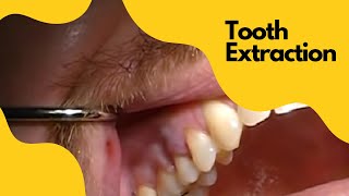 Extraction Tooth 4  Severe Angulation of the root AND a fracture using Physics Forceps [upl. by Oicirbaf]