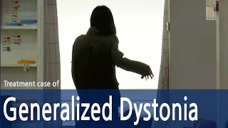 Generalized DystoniaDystoniaCervical dystoniaSpasmodic Torticollis  전신 사경증  근긴장이상증 [upl. by Areht448]