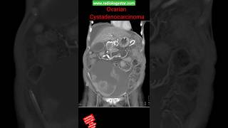 Ovarian Cystadenocarcinoma shorts radiology youtubeshorts [upl. by Wessling]