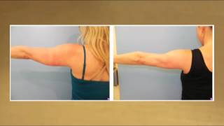 Laser Lipo for Slimmer Arms  Testimonial [upl. by Walston]