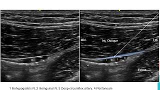 Ilioinguinal Iliohypogastric [upl. by Eidob210]