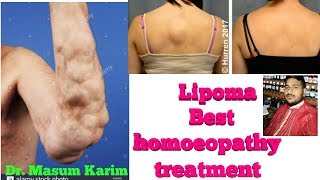 Lipoma homeopathy best medicine how to treatment lipoma without surgery [upl. by Erdnassak257]