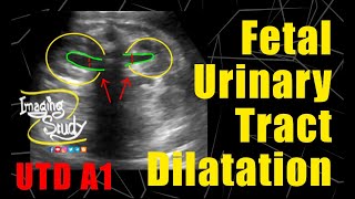 Fetal Urinary Tract Dilatation UTD  Ultrasound  Anomaly  Case 217 [upl. by Sigrid475]