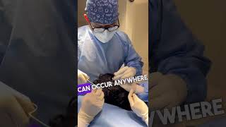 Lipoma excision surgery celebritysurgeon acaseinmysurgurylife Dr Varun Nambiar [upl. by Goldarina]