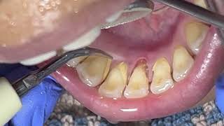 Scaling teeth and removing tartar [upl. by Trbor]