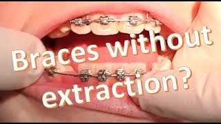 Nonextraction Orthodontics 2x4 Dgainer Mechanics [upl. by Abehshtab410]