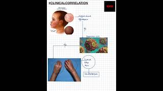 Shorts ClinicalCorrelation NEETNEXTPGFMGEMBBS PARVOVIRUS B19  SCLERODERMA [upl. by Allenotna]