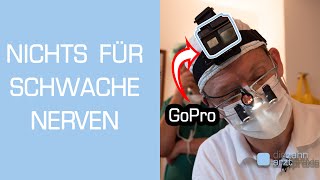 Zahnarzt filmt Weisheitszahn OP mit GoPro Vollnarkose [upl. by Ecinue]