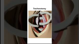 Tracheostomy shorts mbbs femalereproductivesystem pregnancy [upl. by Yttisahc]