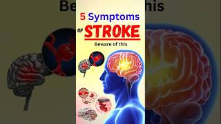 5 Symptoms of Stroke Beware of this [upl. by Llerrac]