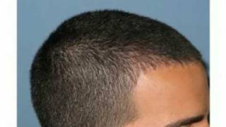 FUE hair transplant hairline example by Dr Paul Shapiro of Shapiro Medical Group [upl. by Rexfourd]