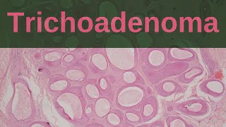 Trichoadenoma  Pathology mini tutorial [upl. by Rask290]