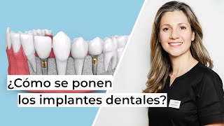 ¿Cómo se ponen los implantes dentales paso a paso  Clínica dental en Alcobendas Avodent [upl. by Amjan184]