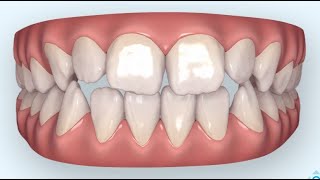 Jugendliche offener Biss Beispiel InvisalignR Zahnspange durchsichtig [upl. by Annaihs]