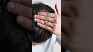 Minoxidil  Uses  Side Effects  Precautions shorts viralvideo [upl. by Andrey]