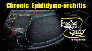 Chronic Epididymoorchitis  Ultrasound  Case 328 [upl. by Atnahc]