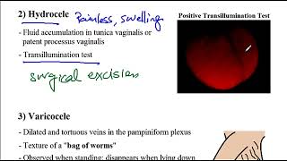 Video 257 Testicular Abnormalities Cryptorchidism Hydrocele Varicocele Torsion and Epididymitis [upl. by Nolrak]