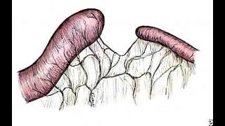 Jejunoileal atresia history and etiology [upl. by Pliam986]