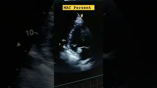 Global LV hypokinesia Severe LV Dysfunction Moderate Aortic stenosis MAC hferf heartfailure [upl. by Cesya]