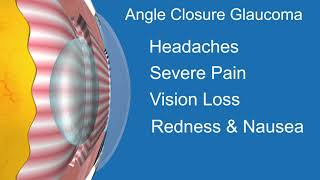 Narrow amp Closed Angle Glaucoma [upl. by Hackathorn]