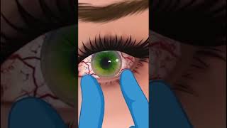 Eyes infection clinging 3D Animation ASMR Video Part2  infected eyes 🤢😷satisfying relaxing [upl. by Nilpik]