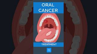 Oral cancer Treatment  Kenhub oralcancer [upl. by Aiken]