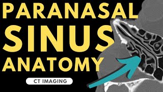 Paranasal Sinuses and Nasal Cavity  Radiology anatomy part 1 prep  CT imaging [upl. by Sedlik137]