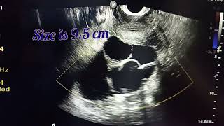 How to diagnose a complex adnexal mass by Simple IOTA RULESvivekanandahospitalofficial [upl. by Adin]