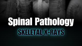 Spinal Pathology Skeletal Xrays [upl. by Irovi]